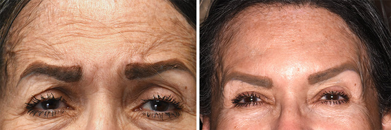 Botox Cosmetic Treatment in Germantown