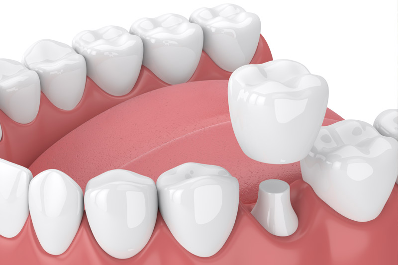 Dental Crowns in Germantown