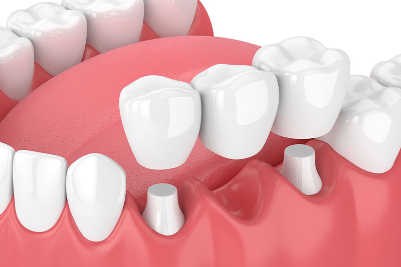 Dental Bridges in Germantown