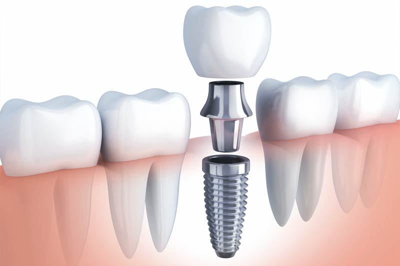 Implants Dentist in Germantown