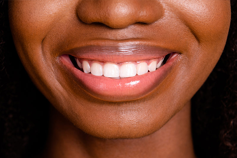 Gum Contouring in Germantown