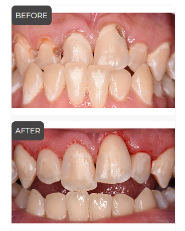 Dental Fillings in Germantown