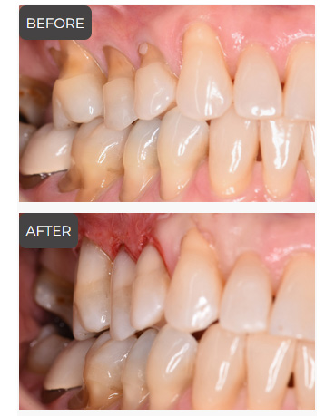 Dental Fillings in Germantown