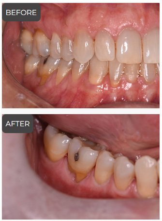 Gum Treatment in Germantown