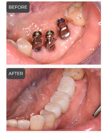 Implants Dentist in Germantown