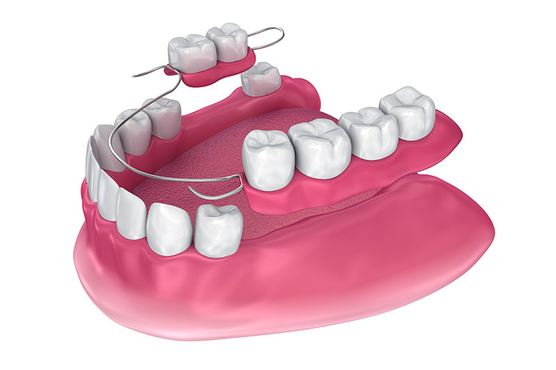 Partial Dentures in Germantown