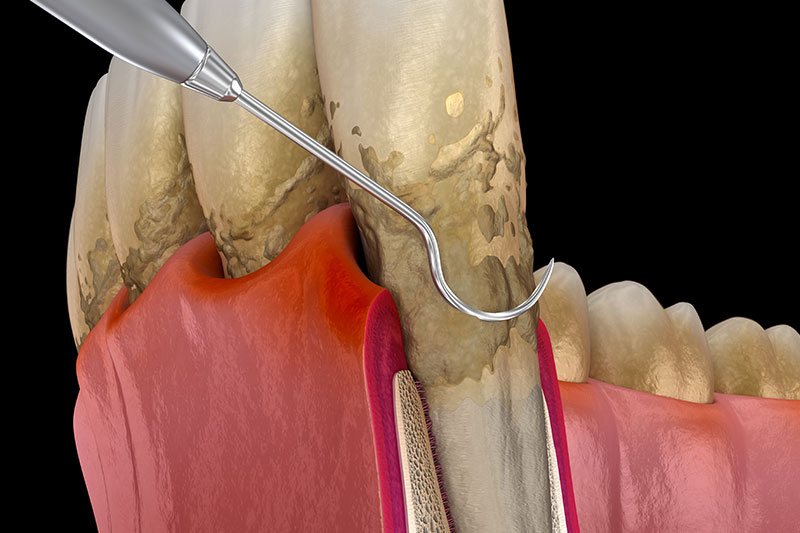 Periodontal Therapy in Germantown