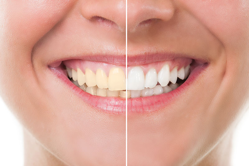 Teeth Whitening in Germantown