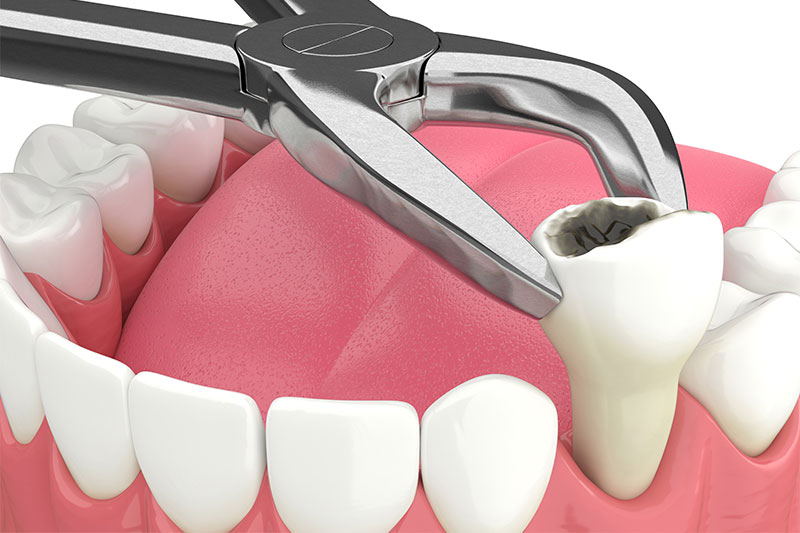 Single Tooth Extraction in Germantown