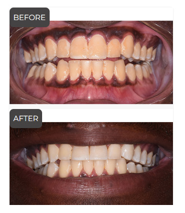 Teeth Whitening in Germantown