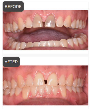 Teeth Whitening in Germantown