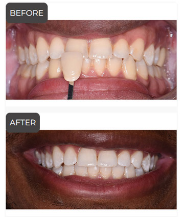 Teeth Whitening in Germantown