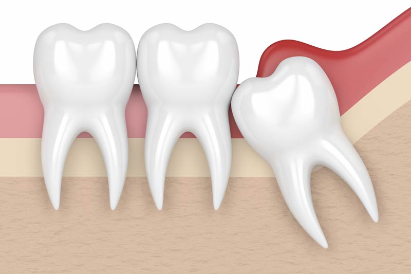 Wisdom Tooth Removal in Germantown